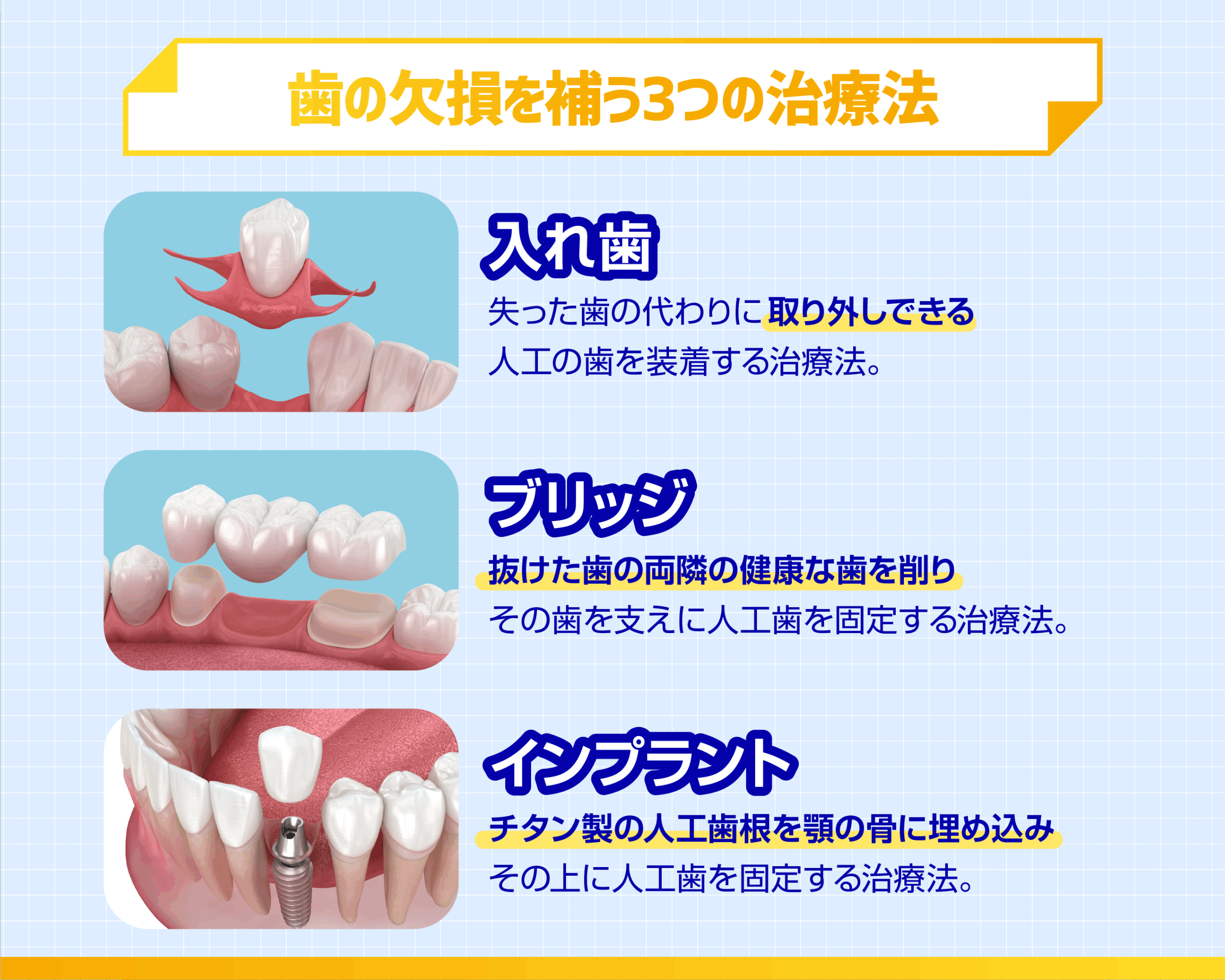 歯の欠損を補う3つの治療法