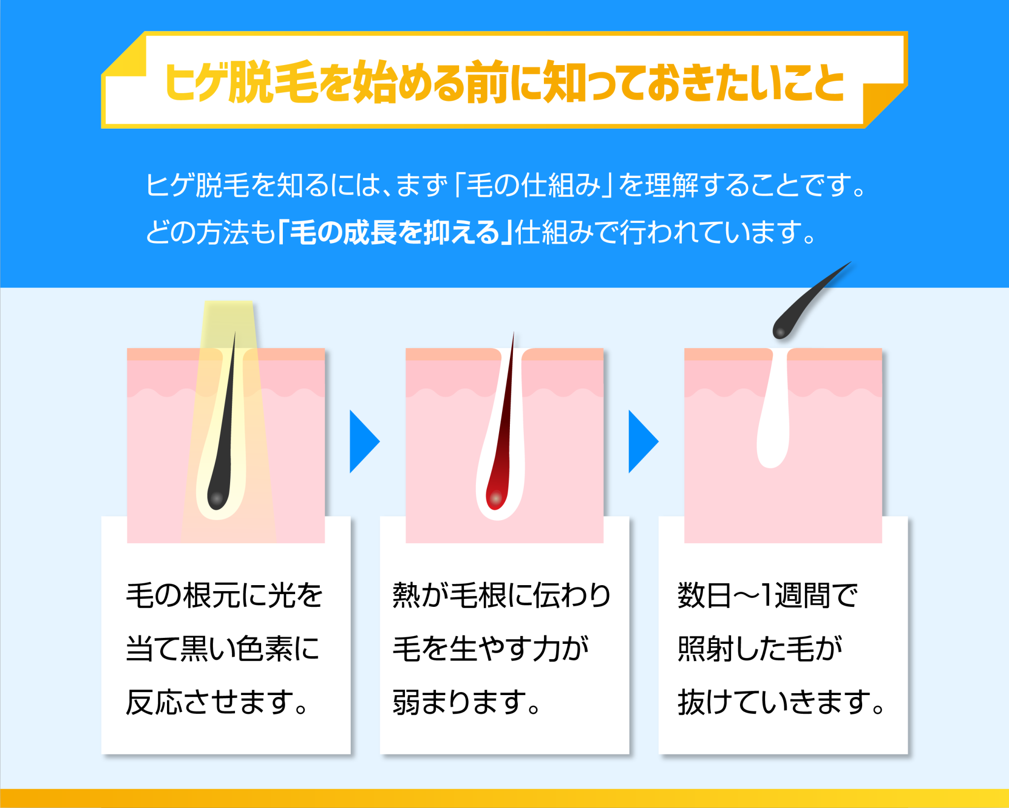 ヒゲ脱毛を始める前に知っておきたいこと
