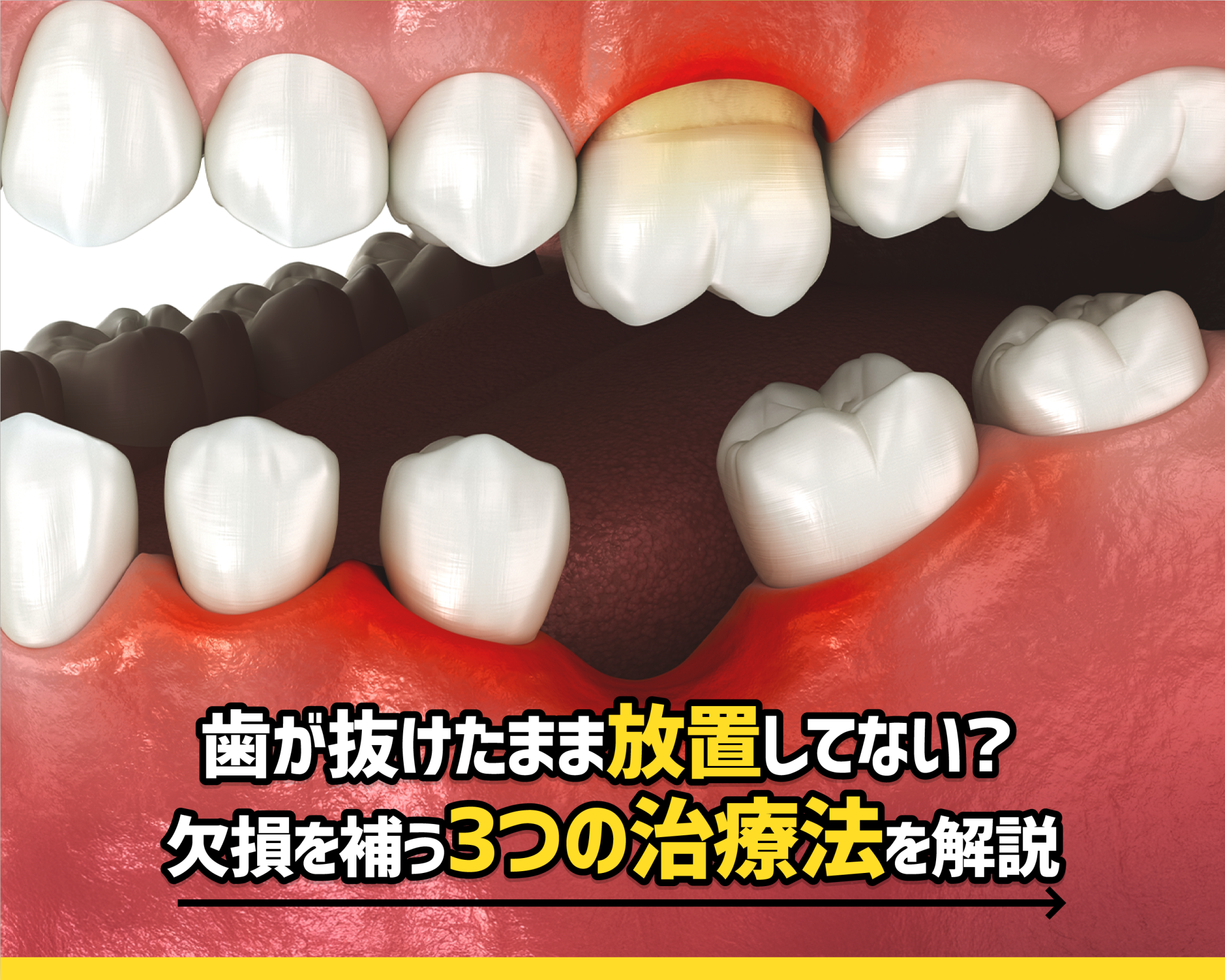 歯が抜けたまま放置してない？欠損を補う3つの治療法を解説