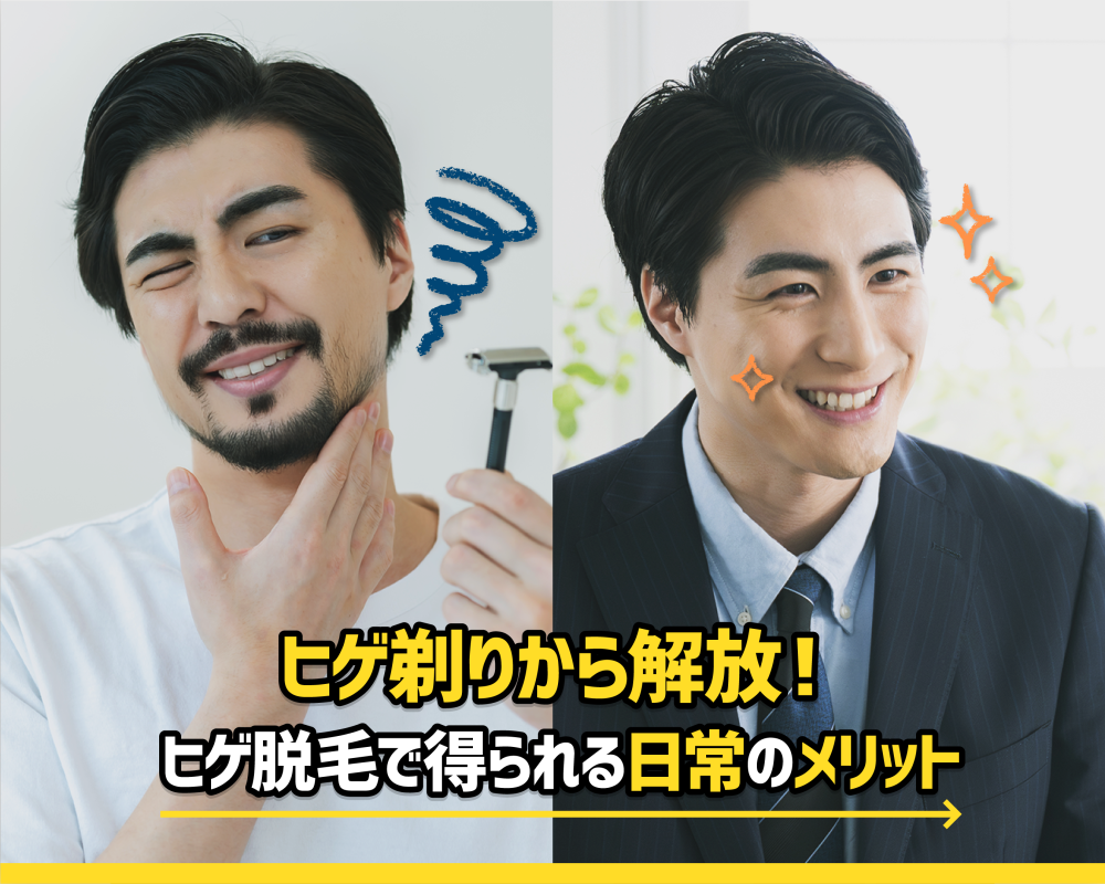 ヒゲ剃りから解放!ヒゲ脱毛で得られる日常のメリット